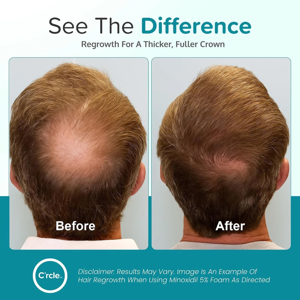 Minoxidil for Men Foam 5%, Unscented 3 Month Supply, Supports Hair Regrowth (Pack of 3)